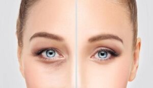 blepharoplastie Superieure ou inferieure